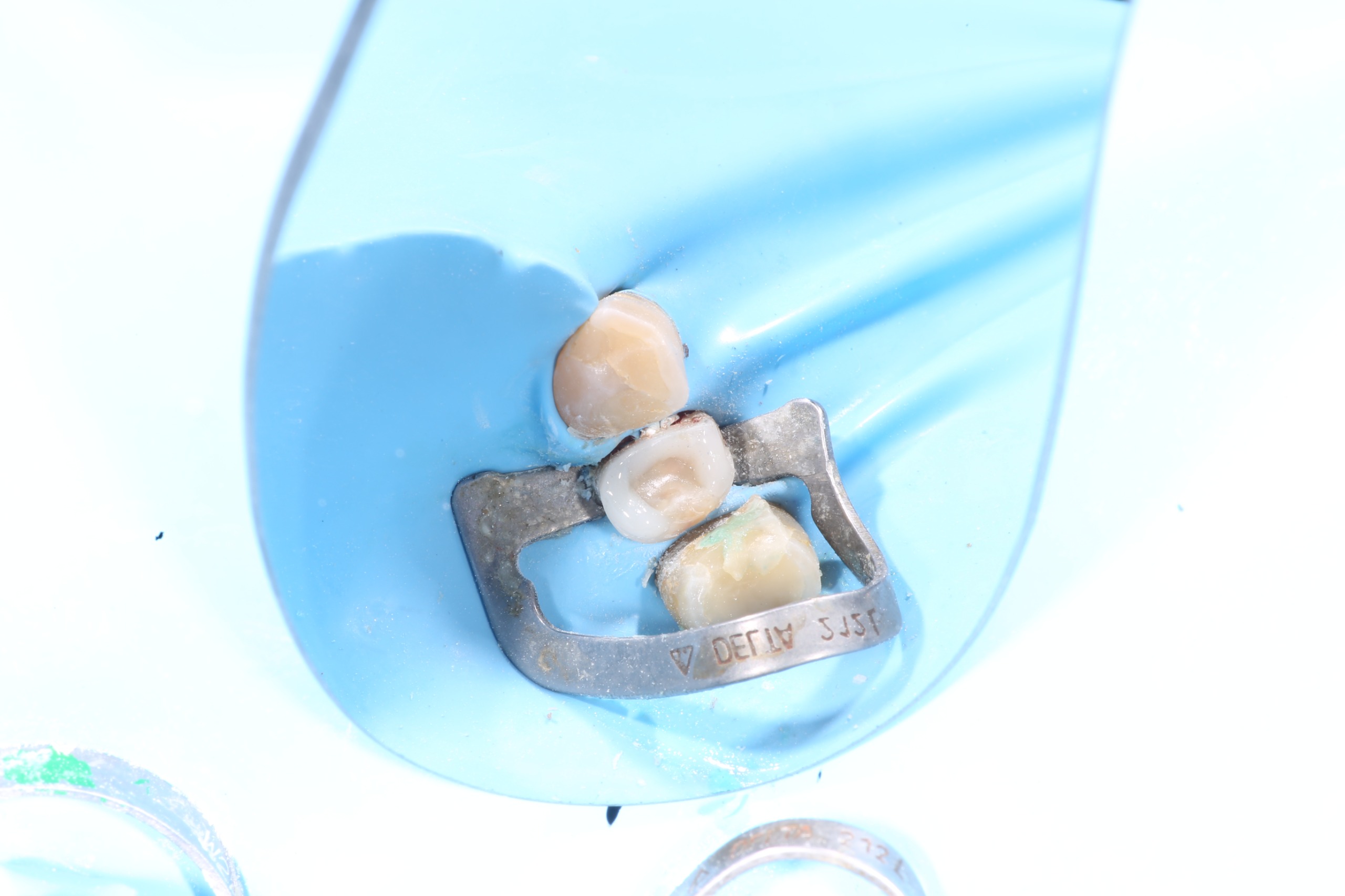 Restauración biomimética con fibras estructurales en Dental Center Córdoba
